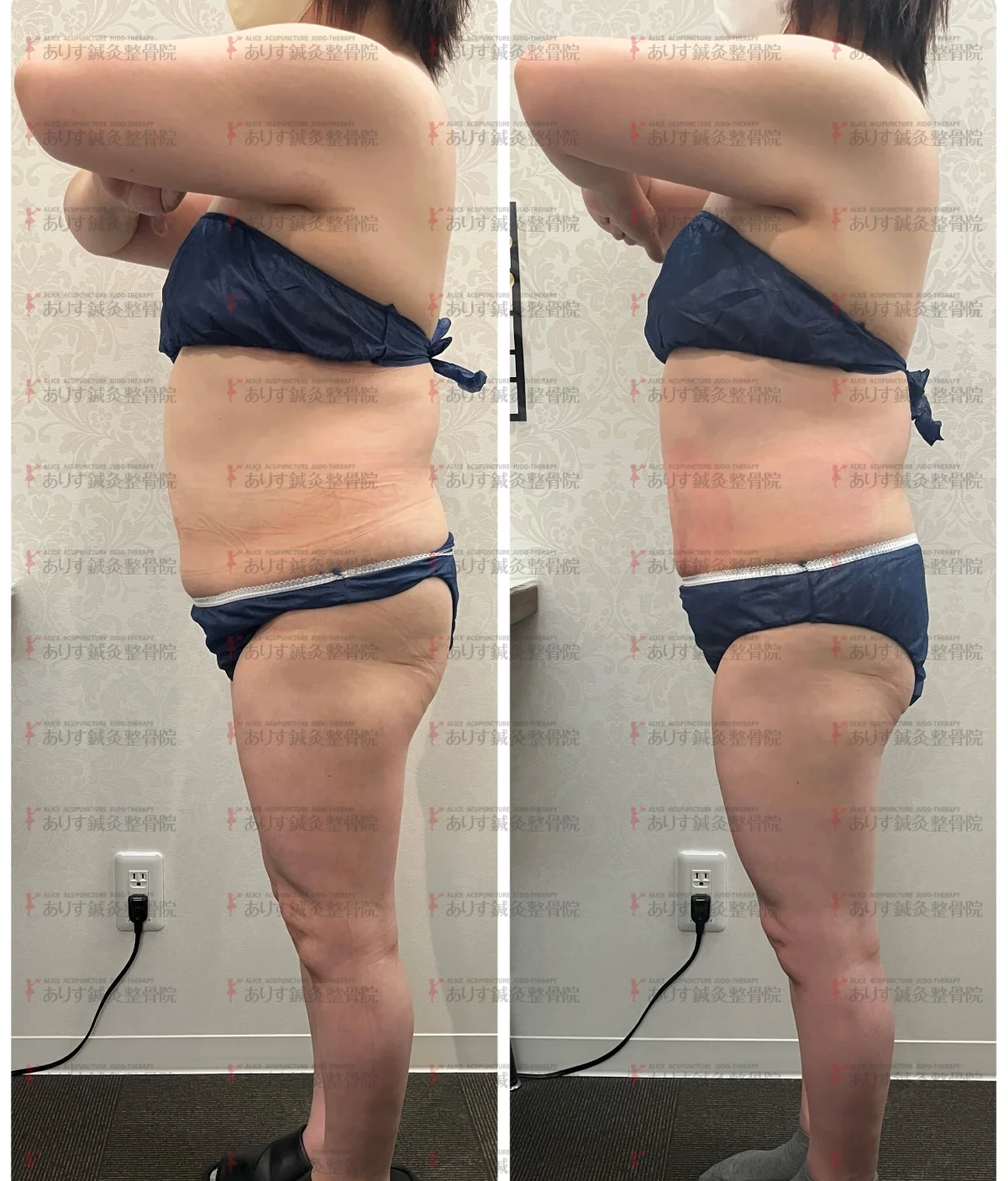 この度、脂肪冷却の機械が最新にパワーアップ！！｜ダイエット