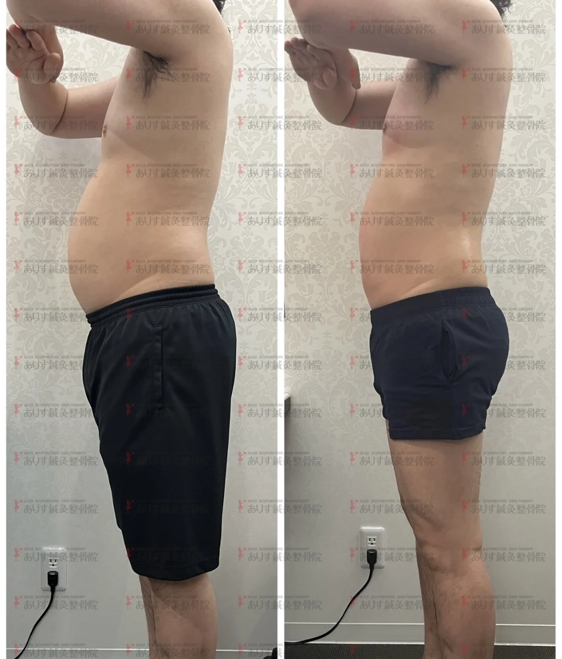 この度、脂肪冷却の機械が最新にパワーアップ！！｜ダイエットなら高松