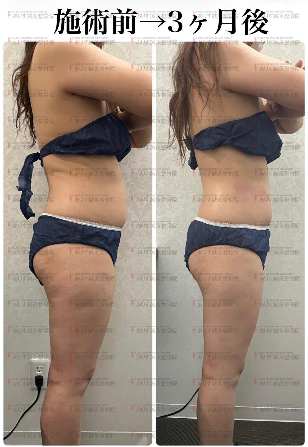 3カ月後－9.5㎝！30代女性、気になる腹周りも脂肪冷却でスピード