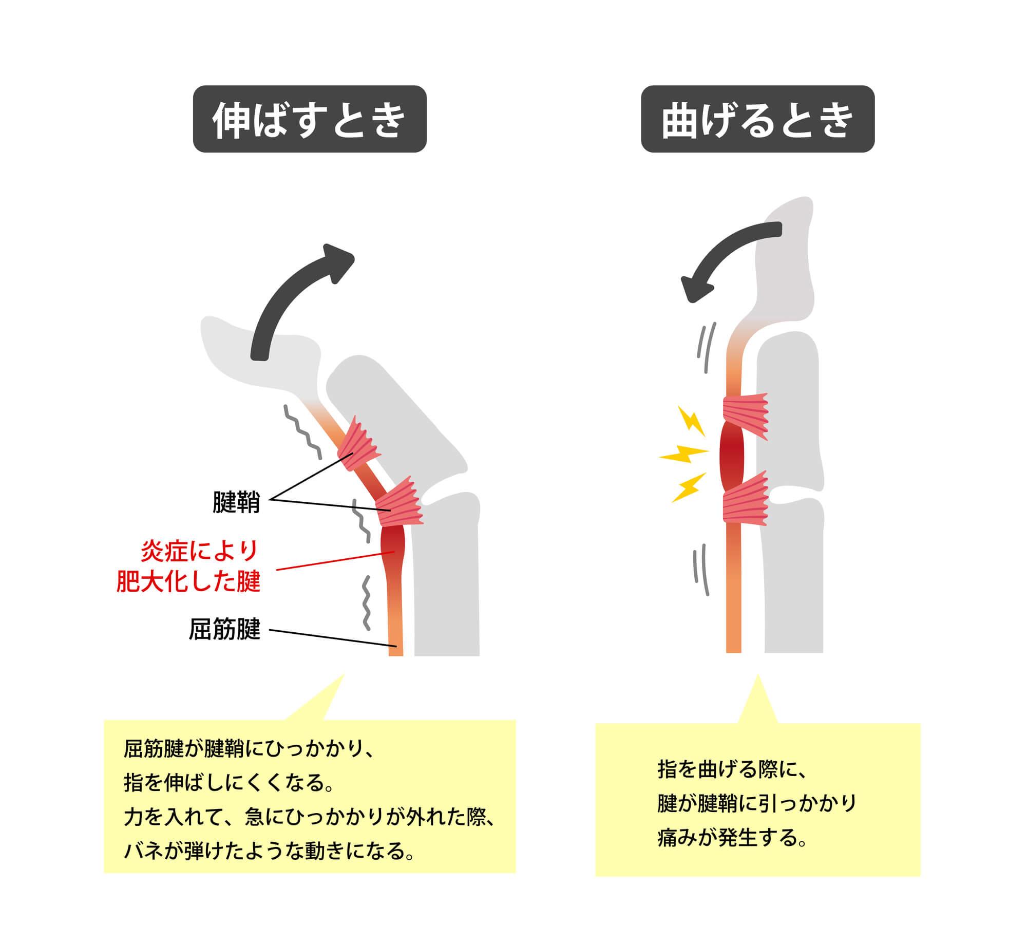 手関節と周辺の疾患について②｜わかくさ整骨院 高松店｜高松市元山町